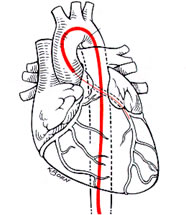 Cardiac Catherization and Life Insurance Quotes