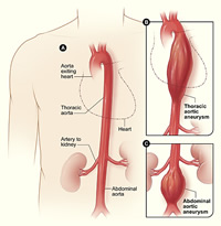 Life insurance aorta and aortic aneurysms