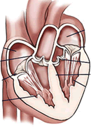 Life insurance rates for aortic valve disorder