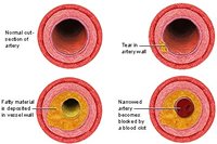 arteriosclerosis and atherosclerosis life insurance quote