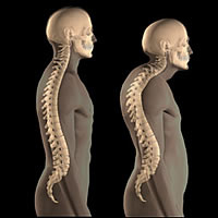 Life insurance rates with osteoporosis