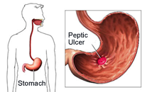 Life insurance rates with peptic ulcer