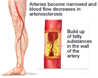 Peripheral Vascular Disease and Life Insurance