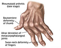 life insurance rates with rheumatoid arthritis